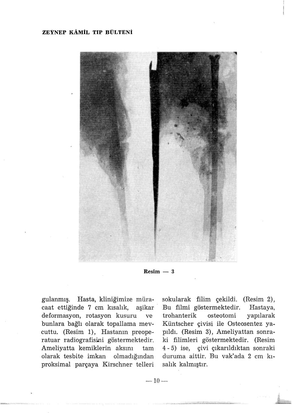 (Resim 1), Hastanın preoperatuar radiografisi.ni göstermektedir.