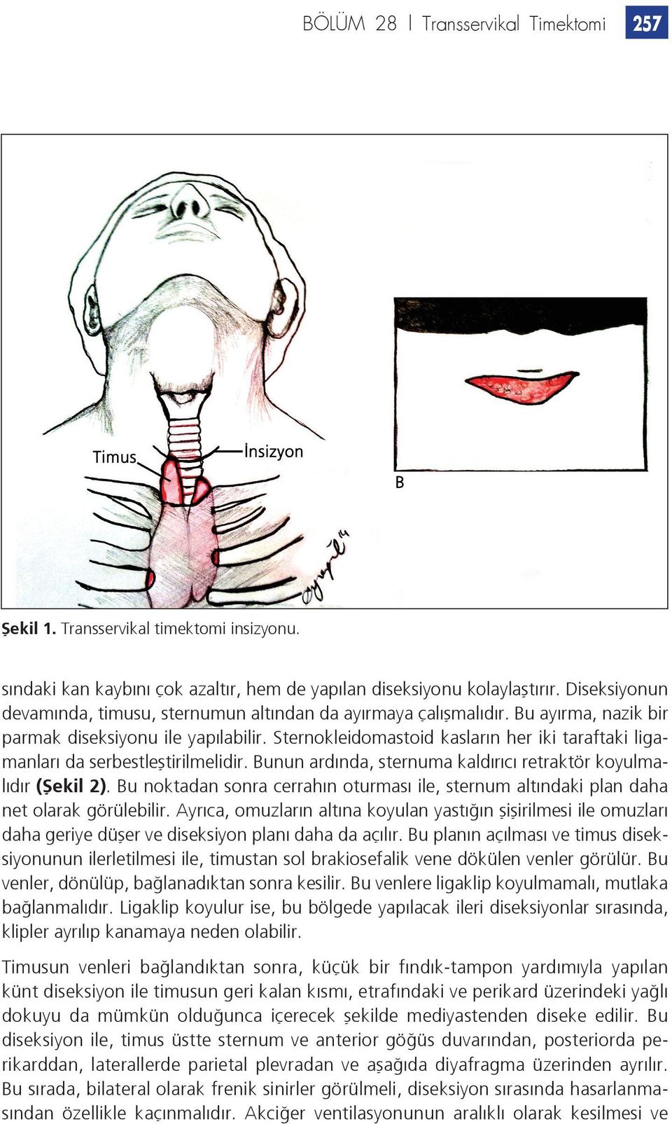 Sternokleidomastoid kasların her iki taraftaki ligamanları da serbestleştirilmelidir. Bunun ardında, sternuma kaldırıcı retraktör koyulmalıdır (Şekil 2).