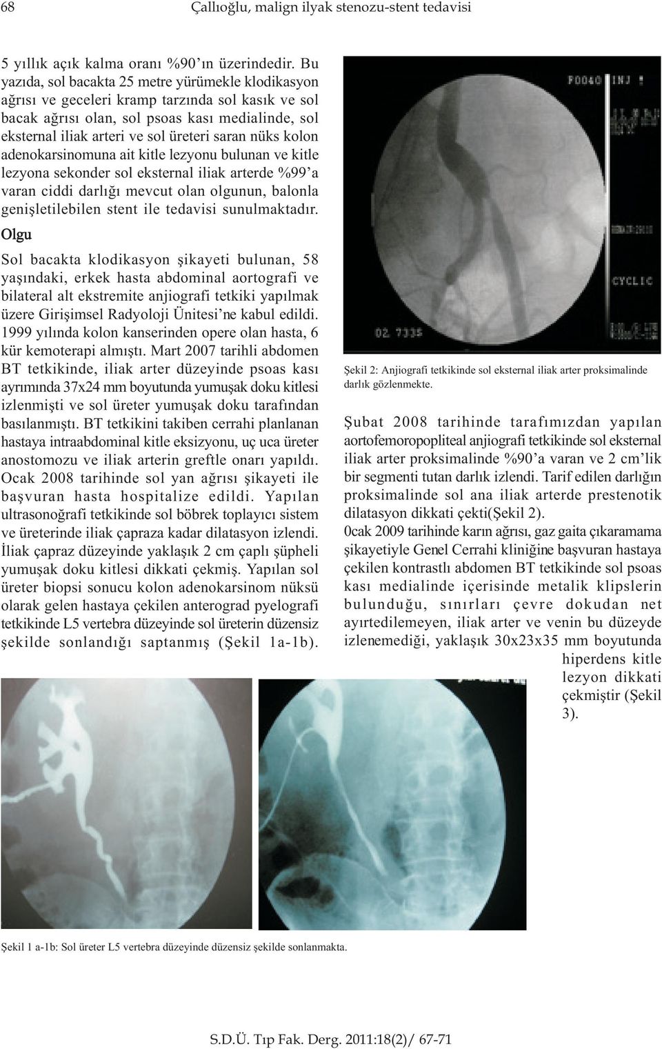 nüks kolon adenokarsinomuna ait kitle lezyonu bulunan ve kitle lezyona sekonder sol eksternal iliak arterde %99 a varan ciddi darlýðý mevcut olan olgunun, balonla geniþletilebilen stent ile tedavisi