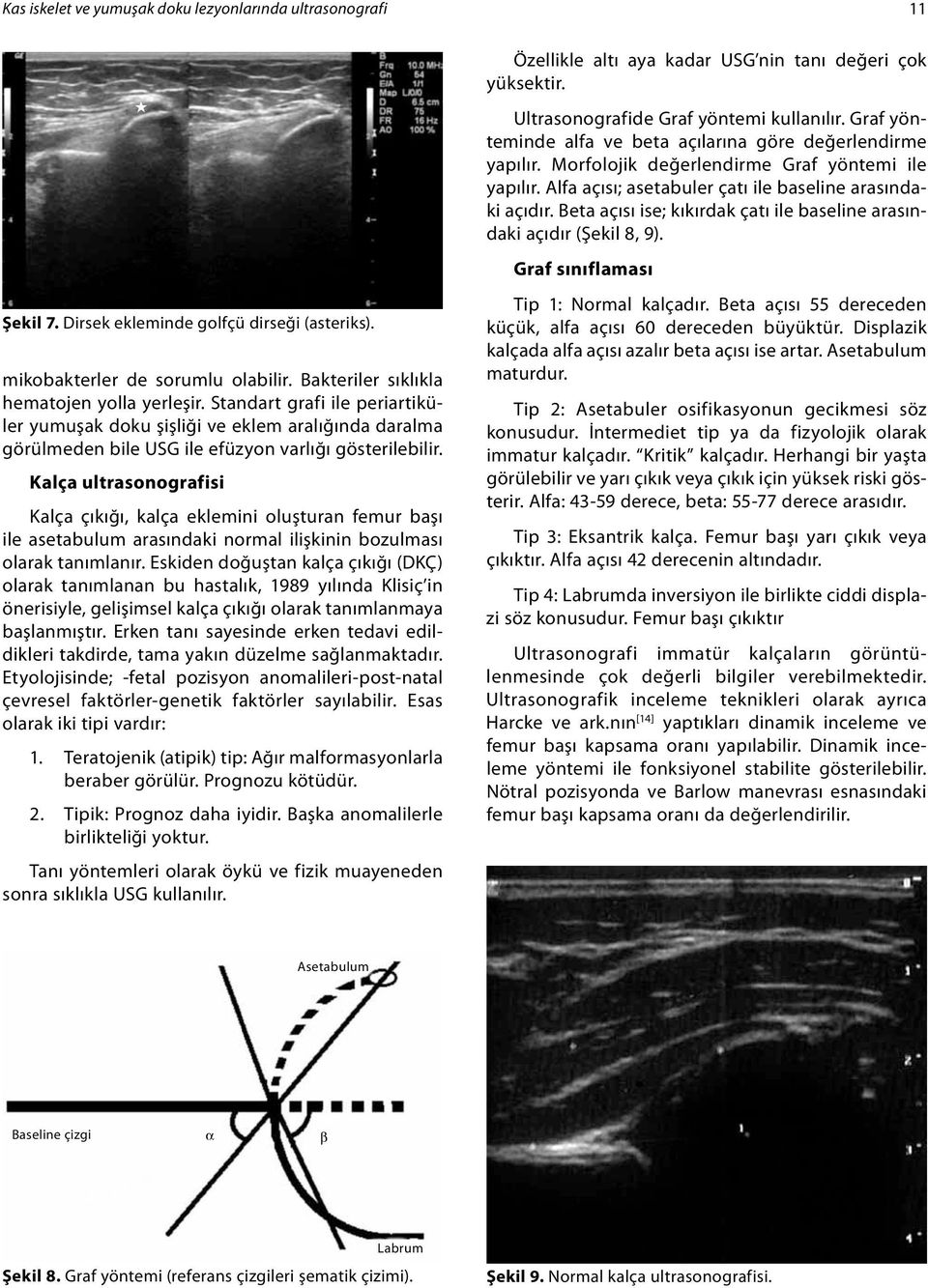 Kalça ultrasonografisi Kalça çıkığı, kalça eklemini oluşturan femur başı ile asetabulum arasındaki normal ilişkinin bozulması olarak tanımlanır.