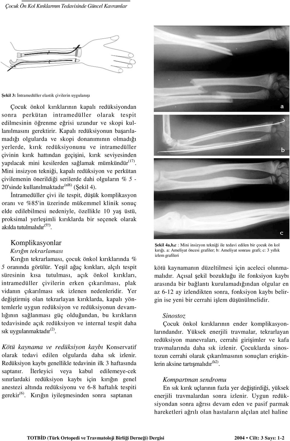 Kapalı redüksiyonun başarılamadığı olgularda ve skopi donanımının olmadığı yerlerde, kırık redüksiyonunu ve intramedüller çivinin kırık hattından geçişini, kırık seviyesinden yapılacak mini