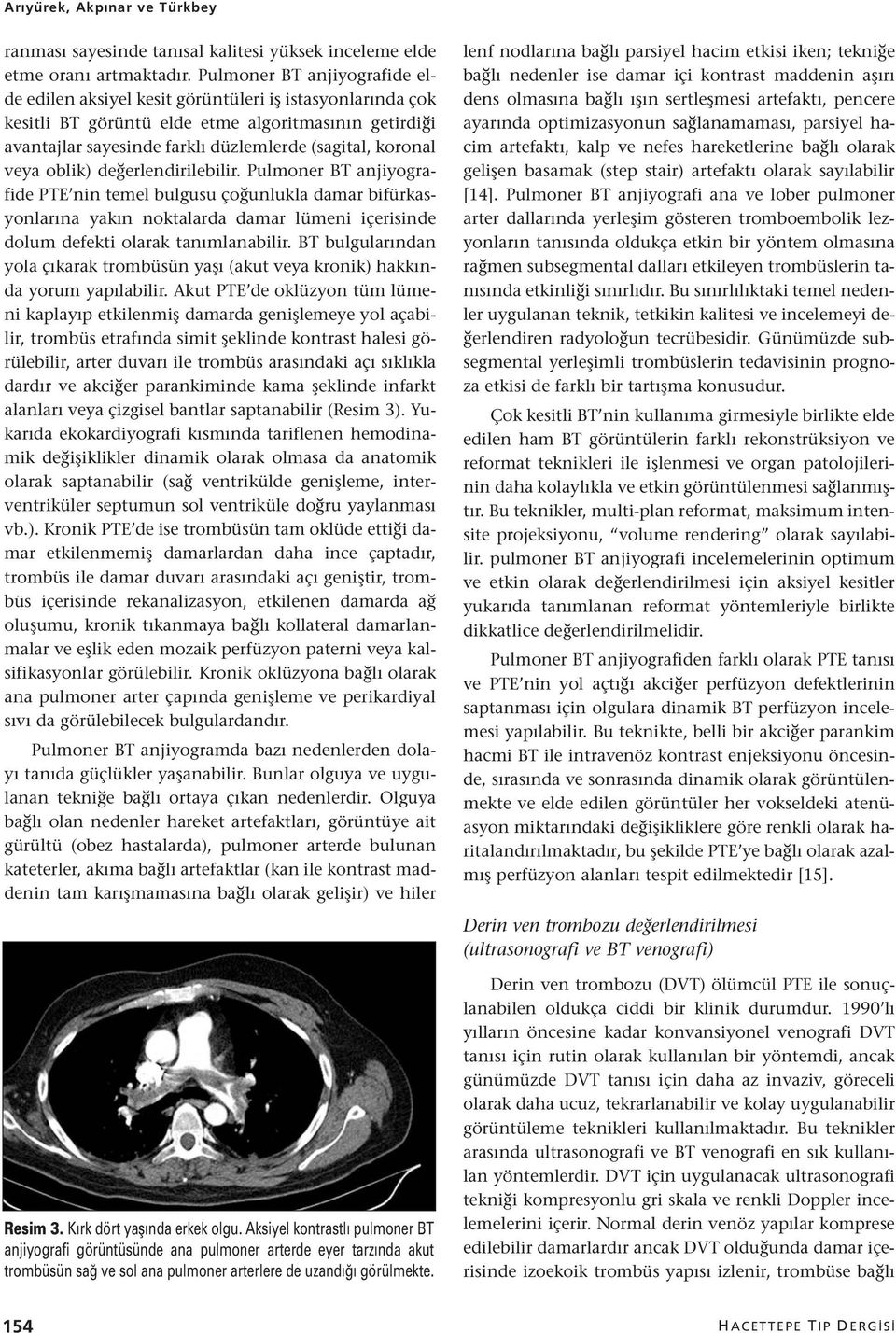 veya oblik) değerlendirilebilir. Pulmoner BT anjiyografide PTE nin temel bulgusu çoğunlukla damar bifürkasyonlarına yakın noktalarda damar lümeni içerisinde dolum defekti olarak tanımlanabilir.