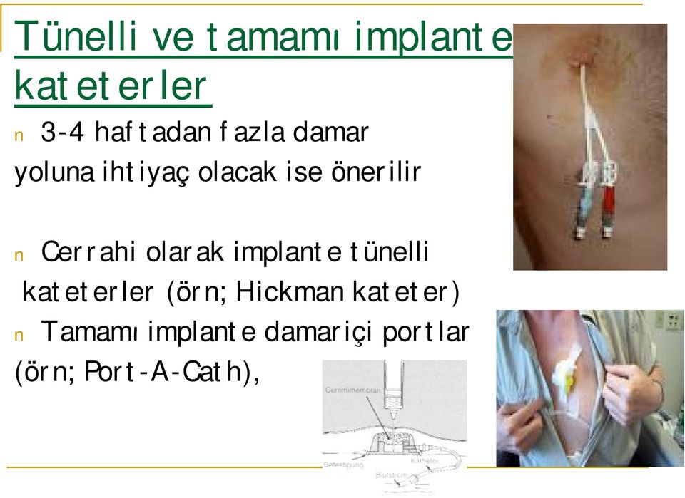 Cerrahi olarak implante tünelli kateterler (örn;