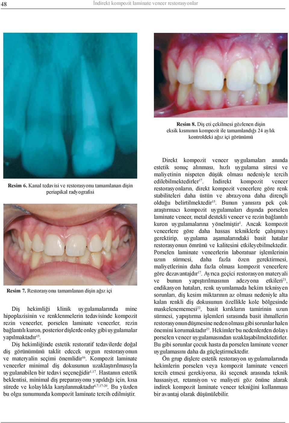 Restorasyonu tamamlanan dişin ağız içi Diş hekimliği klinik uygulamalarında mine hipoplazisinin ve renklenmelerin tedavisinde kompozit rezin veneerler, porselen laminate veneerler, rezin bağlantılı