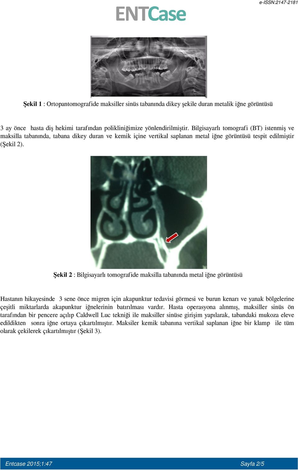 Şekil 2 : Bilgisayarlı tomografide maksilla tabanında metal iğne görüntüsü Hastanın hikayesinde 3 sene önce migren için akapunktur tedavisi görmesi ve burun kenarı ve yanak bölgelerine çeşitli