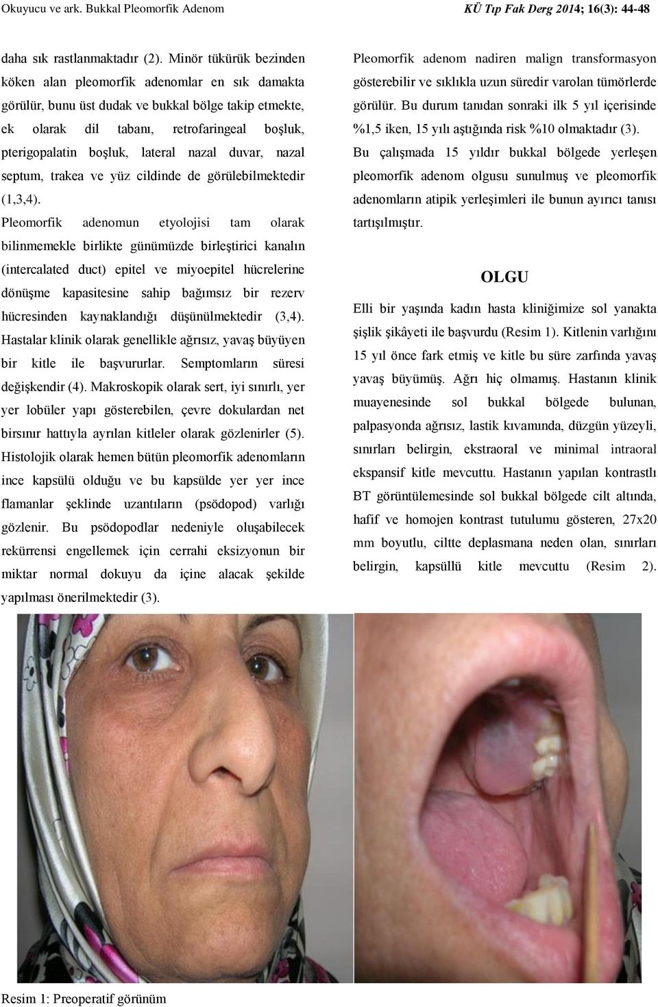 lateral nazal duvar, nazal septum, trakea ve yüz cildinde de görülebilmektedir (1,3,4).