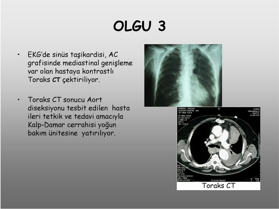 Toraks CT sonucu Aort diseksiyonu tesbit edilen hasta ileri tetkik