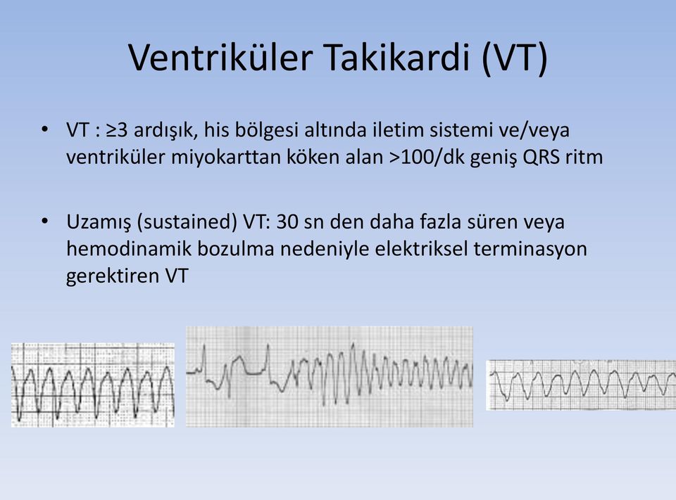 geniş QRS ritm Uzamış (sustained) VT: 30 sn den daha fazla süren