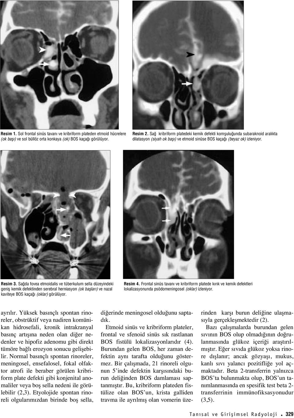 Sa da fovea etmoidalis ve tüberkulum sella düzeyindeki genifl kemik defektinden serebral herniasyon (ok bafllar ) ve nazal kaviteye BOS kaça (oklar) görülüyor. Resim 4.