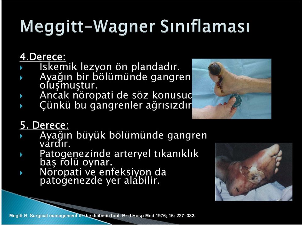 Derece: Ayağın büyük bölümünde gangren vardır. Patogenezinde arteryel tıkanıklık baş rolü oynar.