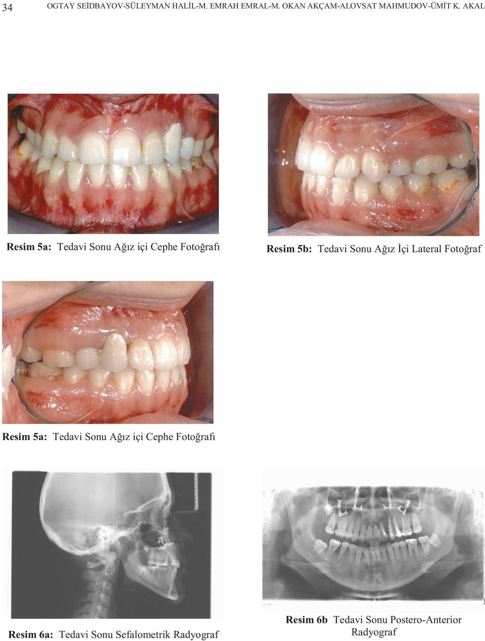 AKAL Resim 5a: Tedavi Sonu Ağız içi Cephe Fotoğrafı Resim 5b: Tedavi Sonu Ağız