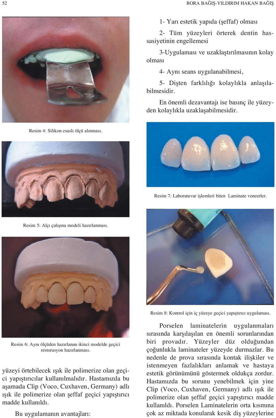 Resim 7: Laboratuvar işlemleri biten Laminate veneerler. Resim 5: Alç çal şma modeli haz rlanmas. Resim 8: Kontrol için iç yüzeye geçici yap şt r c uygulamas.