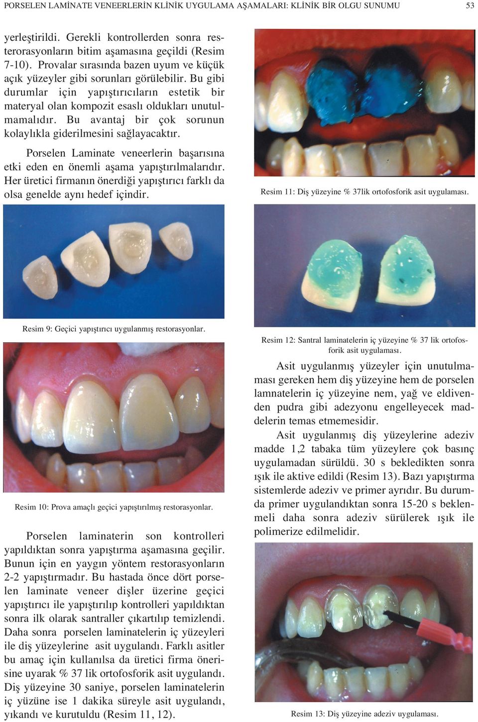 Bu avantaj bir çok sorunun kolayl kla giderilmesini sağlayacakt r. Porselen Laminate veneerlerin başar s na etki eden en önemli aşama yap şt r lmalar d r.