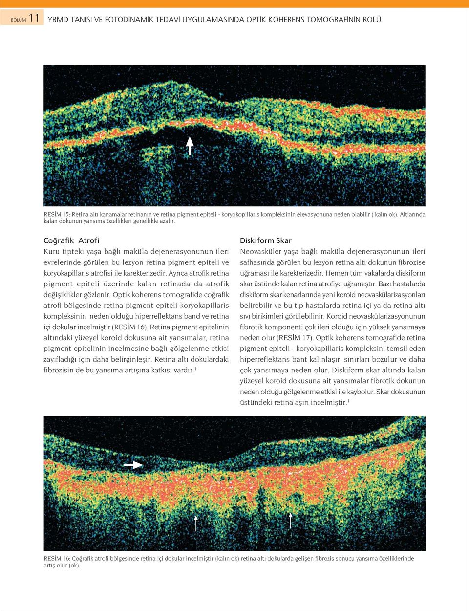 Co rafik Atrofi Kuru tipteki yafla ba l maküla dejenerasyonunun ileri evrelerinde görülen bu lezyon retina pigment epiteli ve koryokapillaris atrofisi ile karekterizedir.