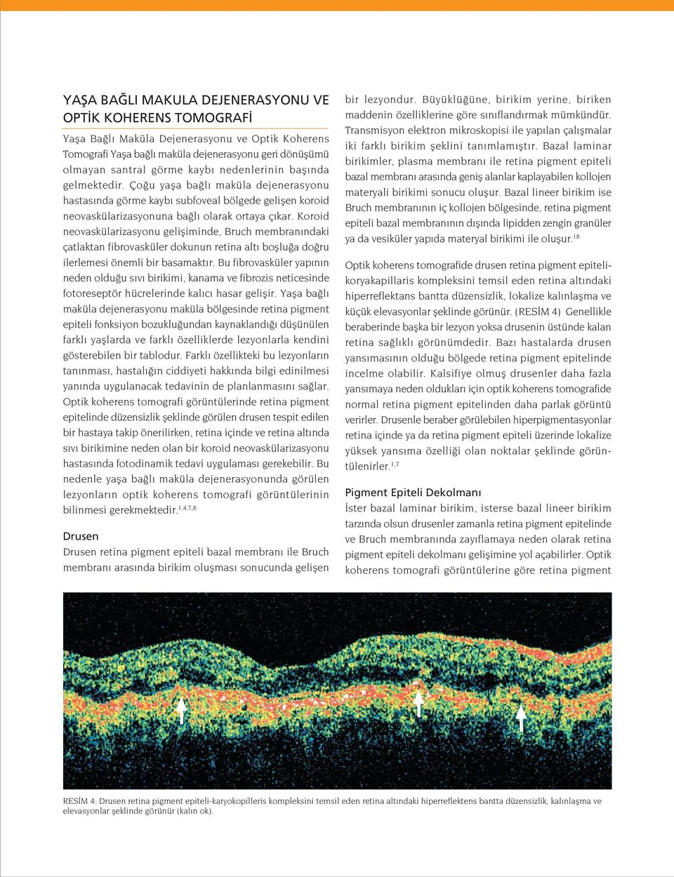 Koroid neovaskülarizasyonu gelifliminde, Bruch membran ndaki çatlaktan fibrovasküler dokunun retina alt bofllu a do ru ilerlemesi önemli bir basamakt r.