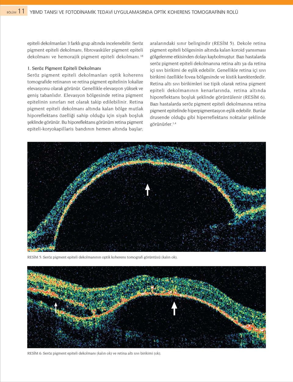 Seröz Pigment Epiteli Dekolman Seröz pigment epiteli dekolmanlar optik koherens tomografide retinan n ve retina pigment epitelinin lokalize elevasyonu olarak görünür.