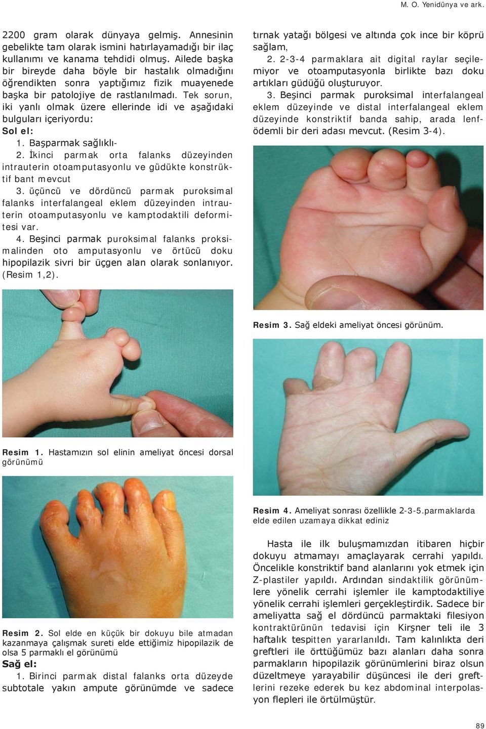 B puroksimal falanks proksimalinden oto amputasyonlu ve örtücü doku (Resim 1,2)., 2. 2-3-4 parmaklara ait digital raylar seçile-. 3.