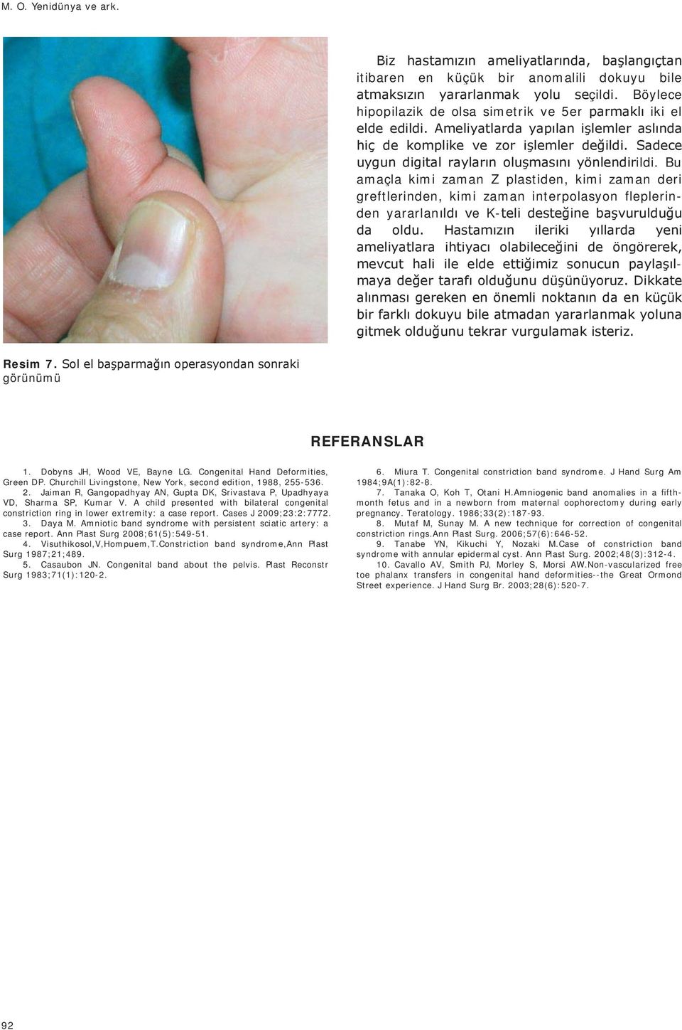Congenital Hand Deformities, Green DP. Churchill Livingstone, New York, second edition, 1988, 255-536. 2. Jaiman R, Gangopadhyay AN, Gupta DK, Srivastava P, Upadhyaya VD, Sharma SP, Kumar V.