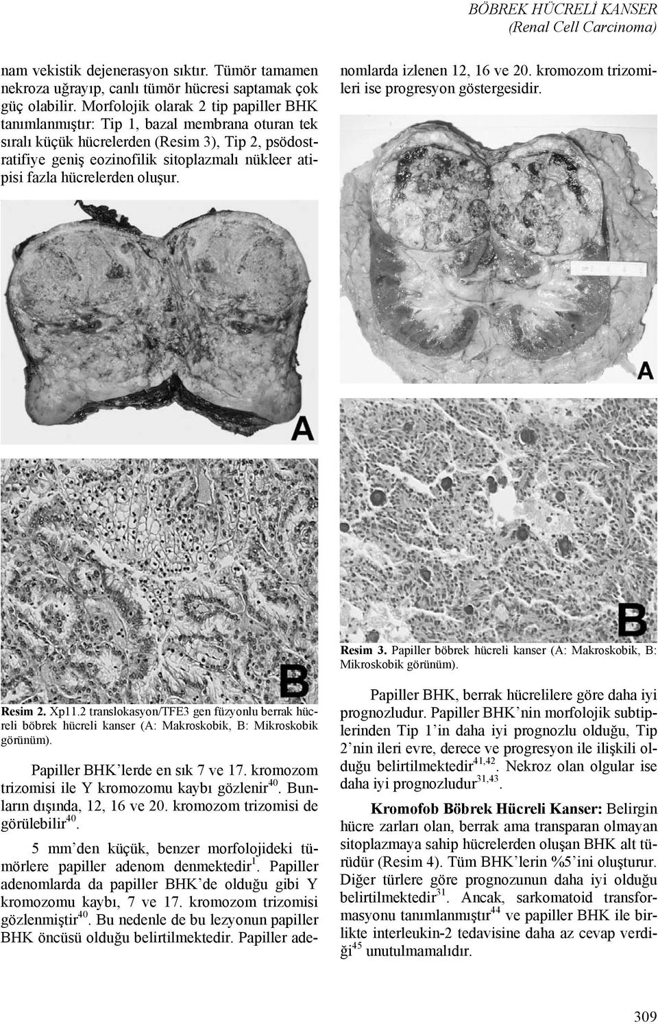 hücrelerden oluşur. Papiller BHK lerde en sık 7 ve 17. kromozom trizomisi ile Y kromozomu kaybı gözlenir 40. Bunların dışında, 12, 16 ve 20. kromozom trizomisi de görülebilir 40.