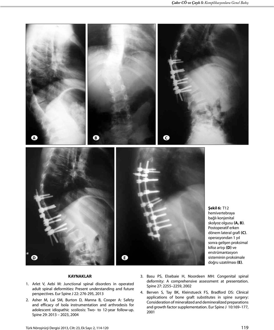 Arlet V, Aebi M: Junctional spinal disorders in operated adult spinal deformities: Present understanding and future perspectives. Eur Spine J 22: 276-295, 2013 2.