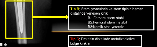 PERIPROSTETIK FEMUR KıRıKLARı Tedavi Tip A Tip B TipC Stabil kırıklar, konservatif takip edilir.