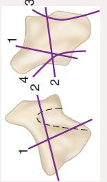 Trapezium Kırık Sınıflaması (Walker) Walker JL, Greene TL, Lunseth PA.