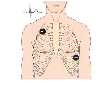 PSG de EKG