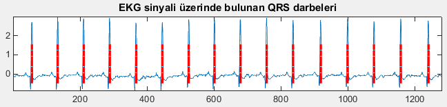 Adım 2. QRS aralığı: Q aralığı toplam QRS nin %25 ini geçemez ve QRS nin toplam süresi 0,11 sn yi aşamaz. Ayrıca Q<0,04 sn olmalıdır.