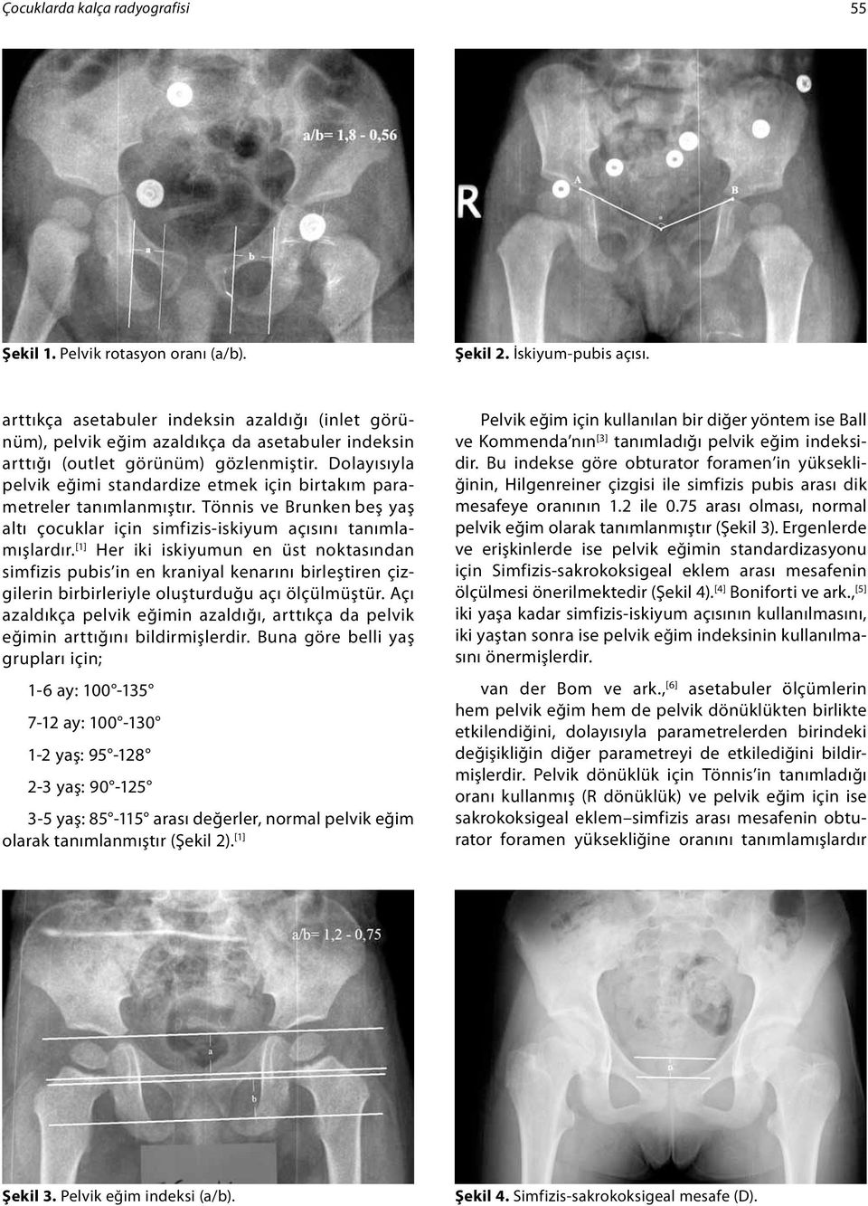 Dolayısıyla pelvik eğimi standardize etmek için birtakım parametreler tanımlanmıştır. Tönnis ve Brunken beş yaş altı çocuklar için simfizis-iskiyum açısını tanımlamışlardır.