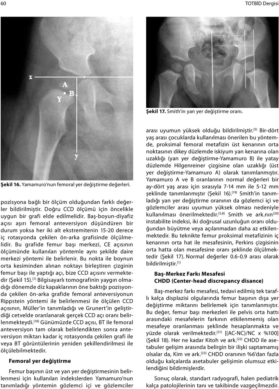 Baş-boyun-diyafiz açısı aşırı femoral anteversiyon düşündüren bir durum yoksa her iki alt ekstremitenin 15-20 derece iç rotasyonda çekilen ön-arka grafisinde ölçülmelidir.