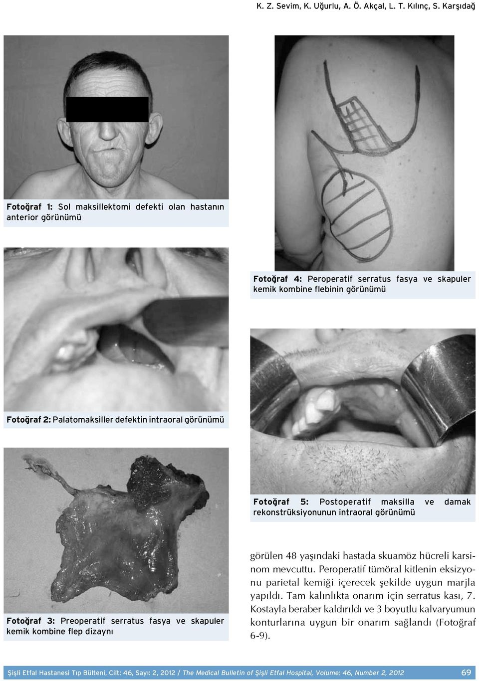 intraoral görünümü Fotoğraf 5: Postoperatif maksilla ve damak rekonstrüksiyonunun intraoral görünümü Fotoğraf 3: Preoperatif serratus fasya ve skapuler kemik kombine flep dizaynı görülen 48 yaşındaki