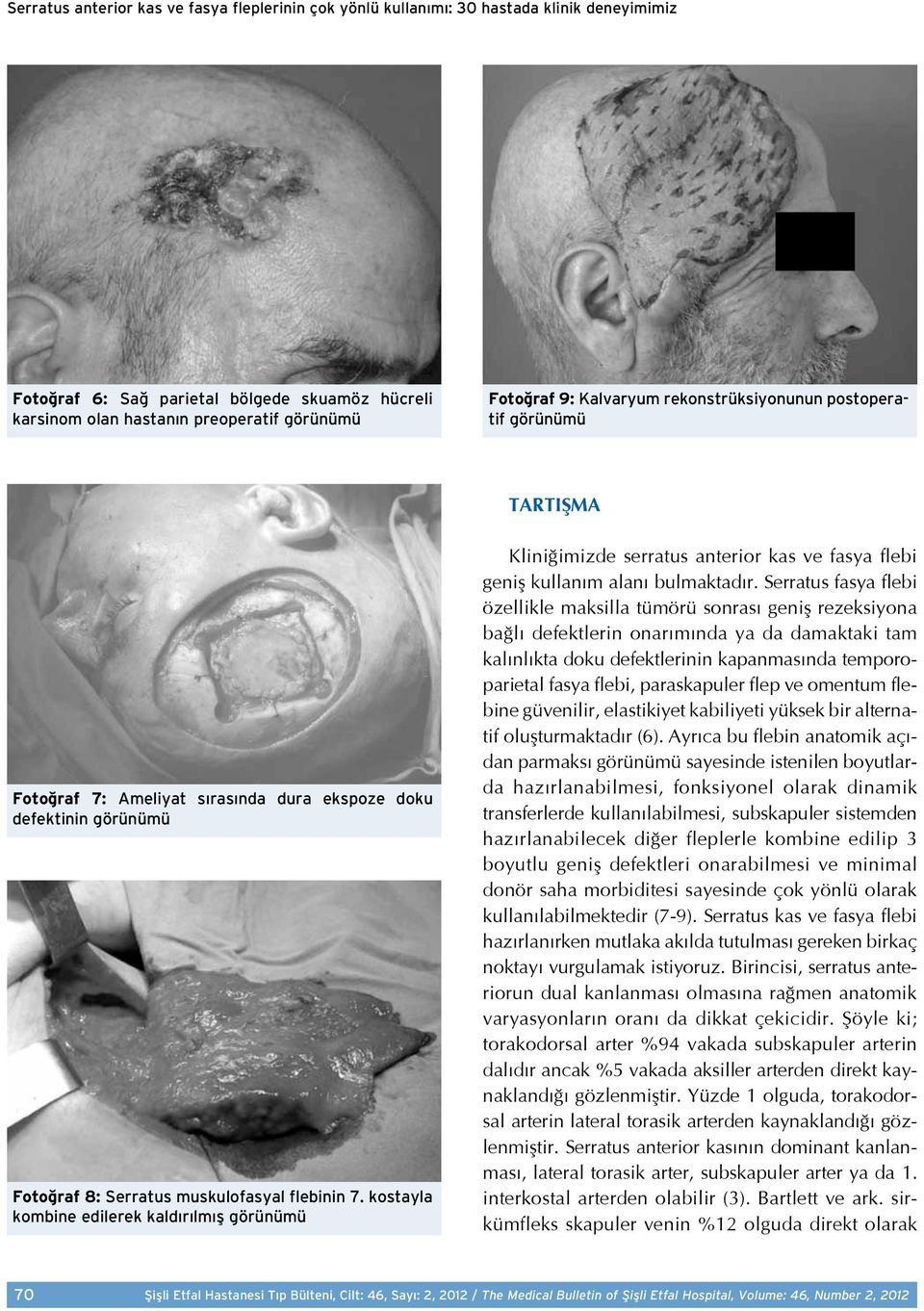 kostayla kombine edilerek kaldırılmış görünümü Kliniğimizde serratus anterior kas ve fasya flebi geniş kullanım alanı bulmaktadır.