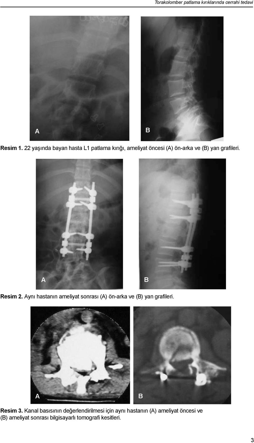 A B Resim 2. Aynı hastanın ameliyat sonrası (A) ön-arka ve (B) yan grafileri. A B Resim 3.
