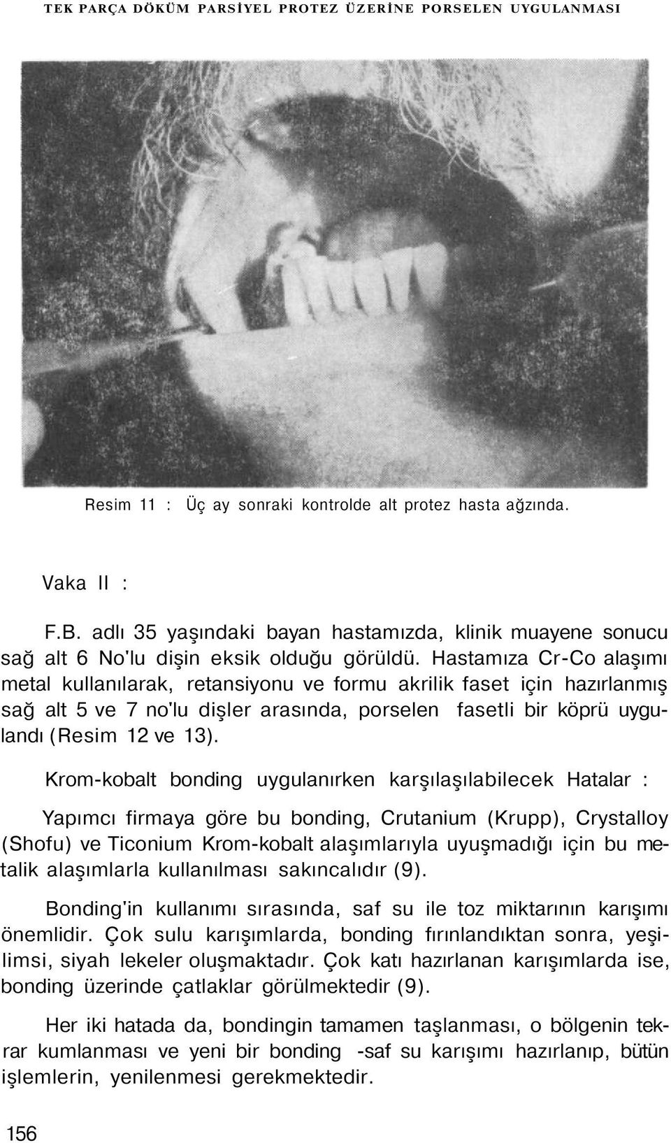 Hastamıza Cr-Co alaşımı metal kullanılarak, retansiyonu ve formu akrilik faset için hazırlanmış sağ alt 5 ve 7 no'lu dişler arasında, porselen fasetli bir köprü uygulandı (Resim 12 ve 13).