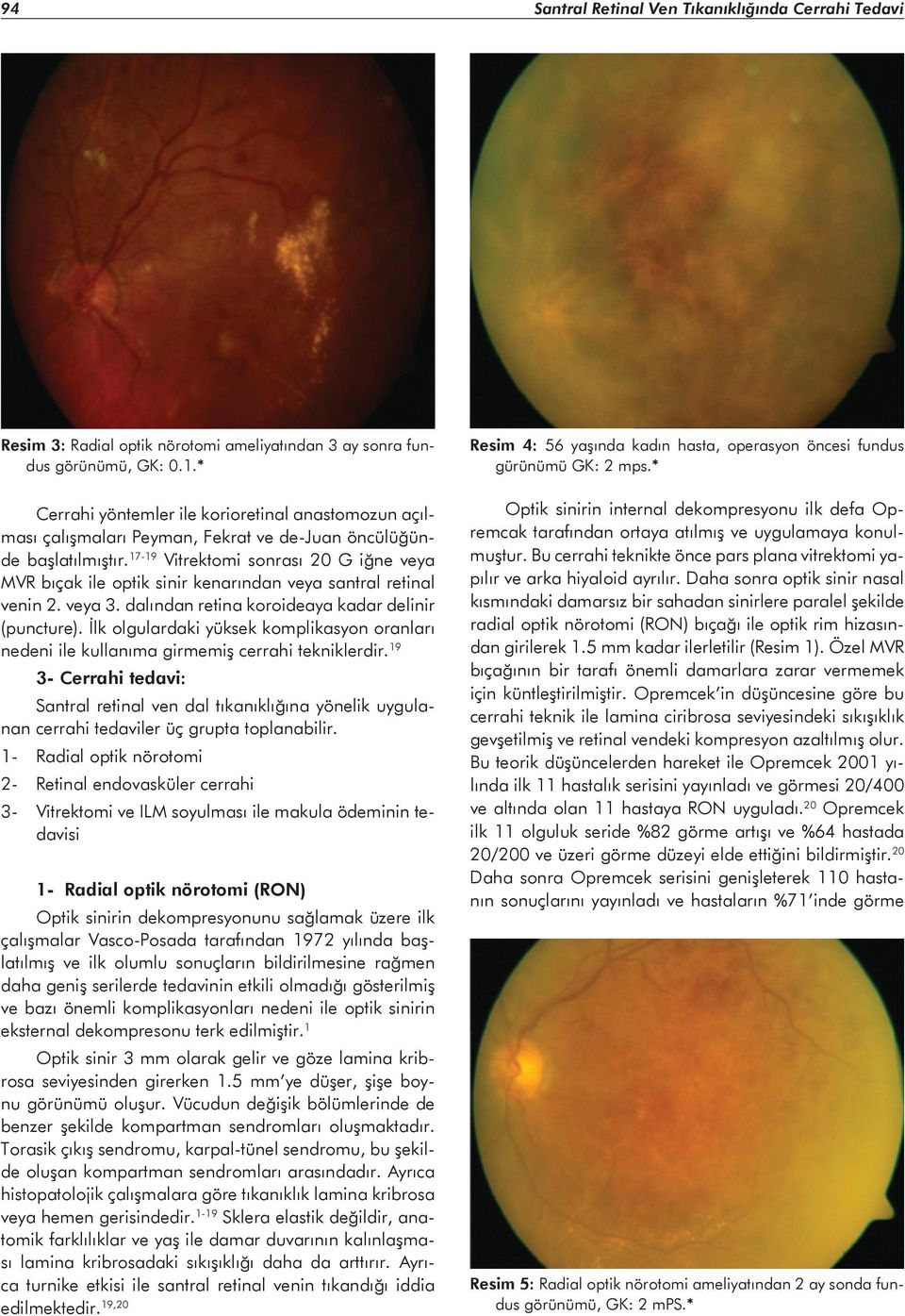 17-19 Vitrektomi sonrası 20 G iğne veya MVR bıçak ile optik sinir kenarından veya santral retinal venin 2. veya 3. dalından retina koroideaya kadar delinir (puncture).