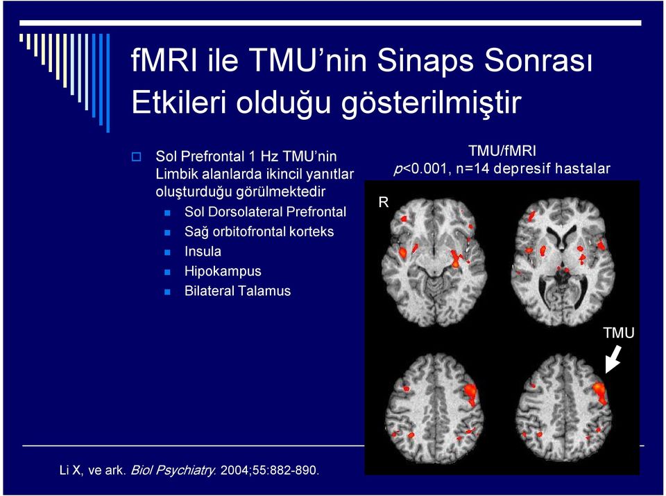 Dorsolateral Prefrontal Sağ orbitofrontal korteks Insula Hipokampus Bilateral
