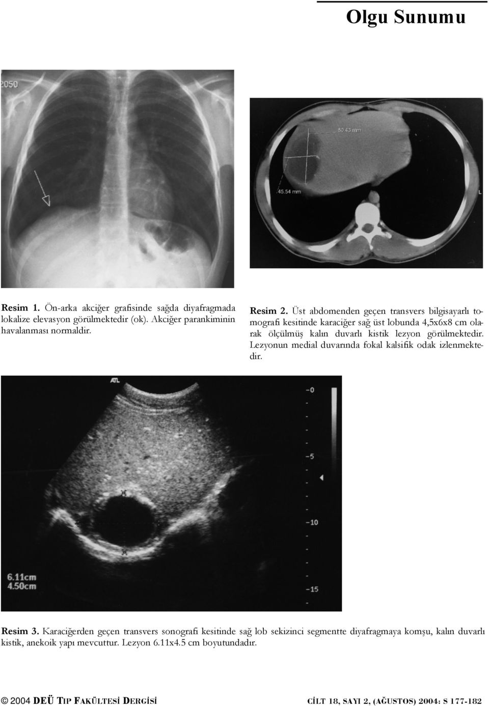 Üst abdomenden geçen transvers bilgisayarlı tomografi kesitinde karaciğer sağ üst lobunda 4,5x6x8 cm olarak ölçülmüş kalın duvarlı kistik lezyon görülmektedir.