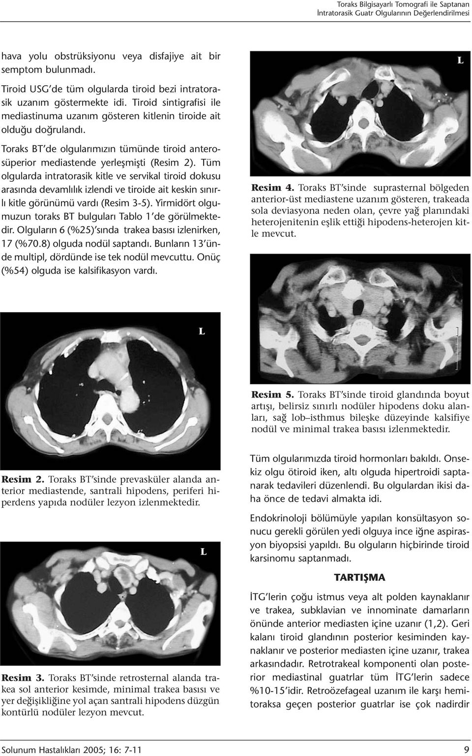 Tüm olgularda intratorasik kitle ve servikal tiroid dokusu arasında devamlılık izlendi ve tiroide ait keskin sınırlı kitle görünümü vardı (Resim 3-5).