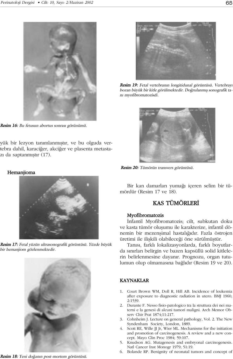 Hemanjioma Resim 20: Tümörün transvers görüntüsü. Bir kan damarlar yuma içeren selim bir tümördür (Resim 17 ve 18). KAS TÜMÖRLER Resim 17: Fetal yüzün ultrasonografik görüntüsü.
