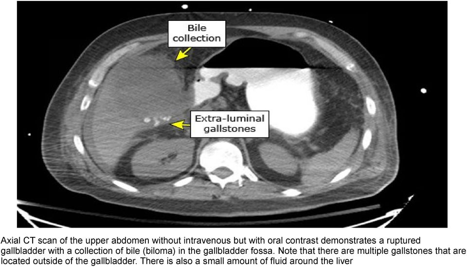 gallbladder fossa.