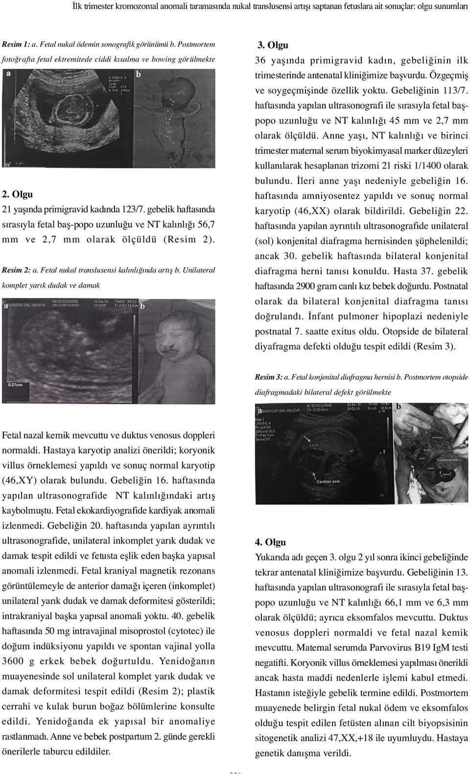 gebelik haftasında sırasıyla fetal ba -popo uzunlu u ve NT kalınlı ı 56,7 mm ve 2,7 mm olarak ölçüldü (Resim 2). Resim 2: a. Fetal nukal translusensi kalınlı ında artı b.