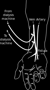 AV Fistül İlk kez 1966 yılında J. Cimino ve M. J. Brescia tarafından kullanılmaya başlamıştır. Anatomik olarak elbileği (radiosefalik) ve dirsek (brakiosefali) primer fistülleri önerilmektedir.