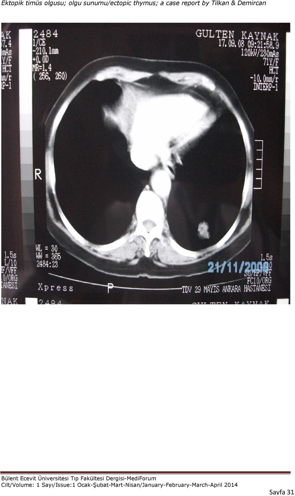 thymus; a case report