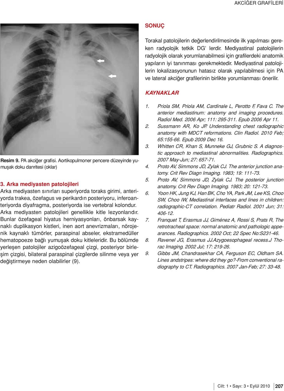 Mediyastinal patolojilerin lokalizasyonunun hatasız olarak yapılabilmesi için PA ve lateral akciğer grafilerinin birlikte yorumlanması önerilir. KAYNAKLAR Resim 9. PA akciğer grafisi.