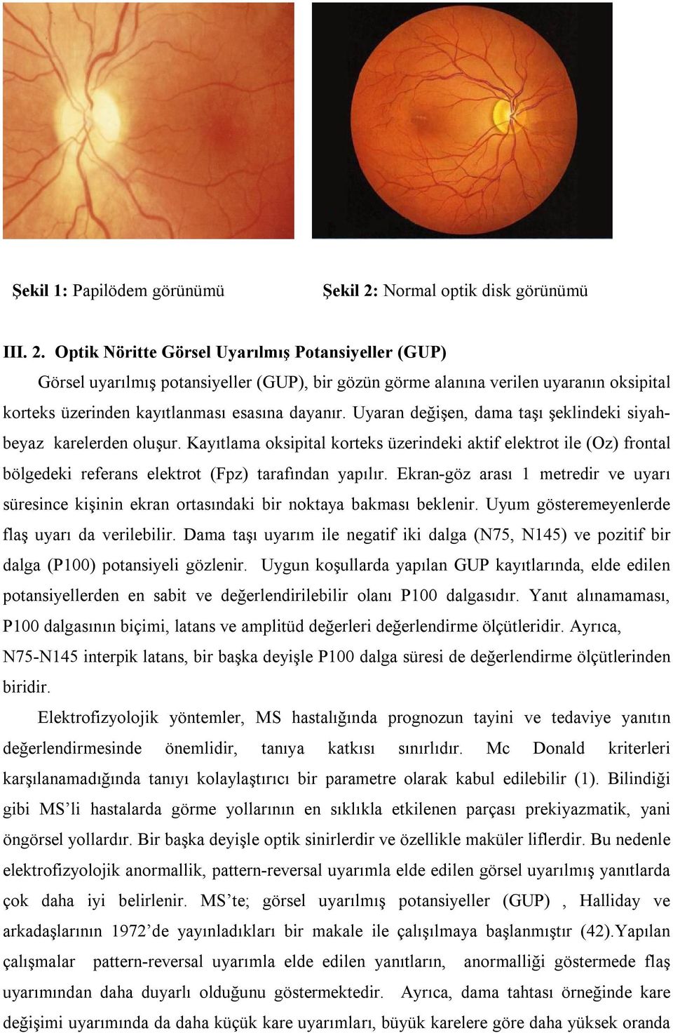 Optik Nöritte Görsel Uyarılmış Potansiyeller (GUP) Görsel uyarılmış potansiyeller (GUP), bir gözün görme alanına verilen uyaranın oksipital korteks üzerinden kayıtlanması esasına dayanır.
