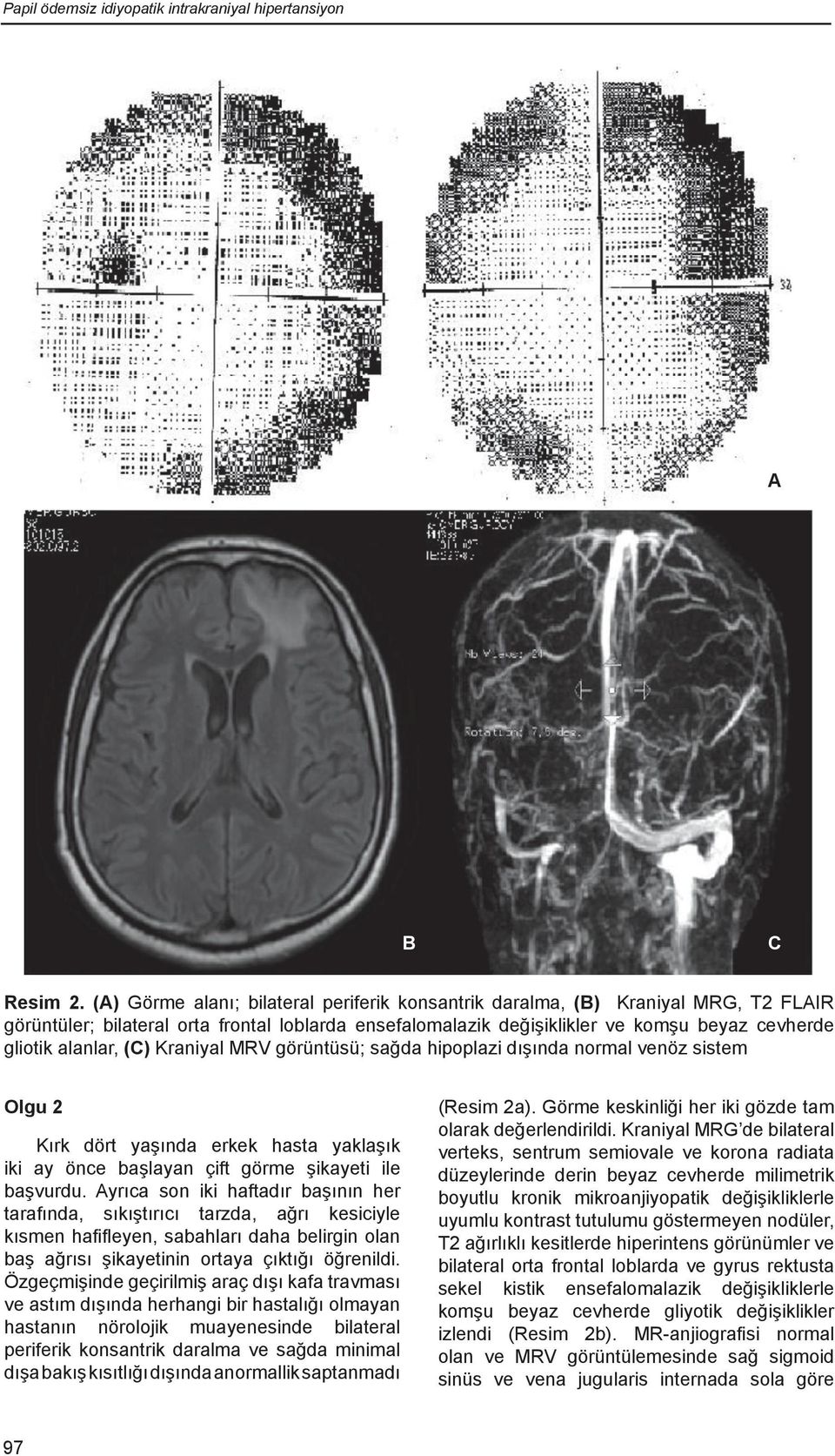 (C) Kraniyal MRV görüntüsü; sağda hipoplazi dışında normal venöz sistem Olgu 2 Kırk dört yaşında erkek hasta yaklaşık iki ay önce başlayan çift görme şikayeti ile başvurdu.