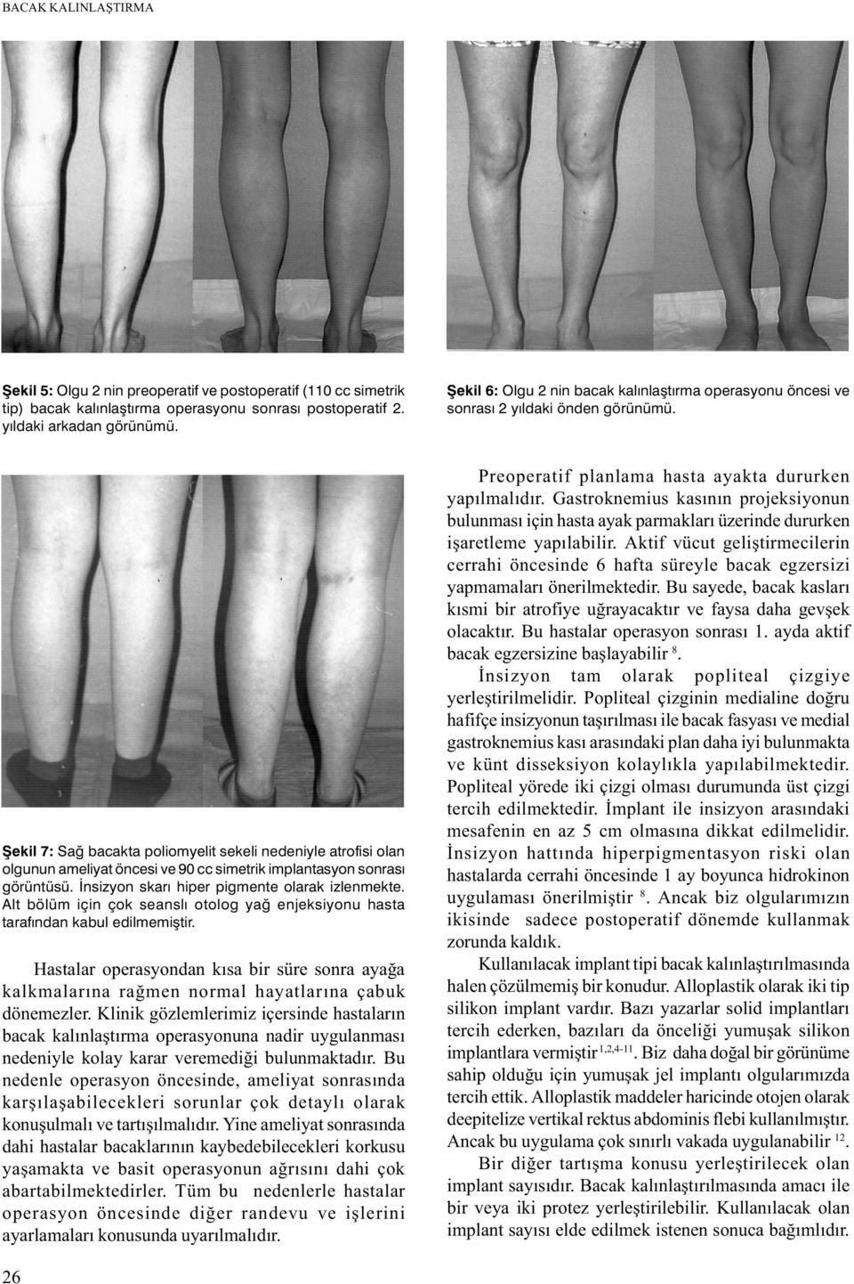 Þekil 7: Sað bacakta poliomyelit sekeli nedeniyle atrofisi olan olgunun ameliyat öncesi ve 90 cc simetrik implantasyon sonrasý görüntüsü. Ýnsizyon skarý hiper pigmente olarak izlenmekte.
