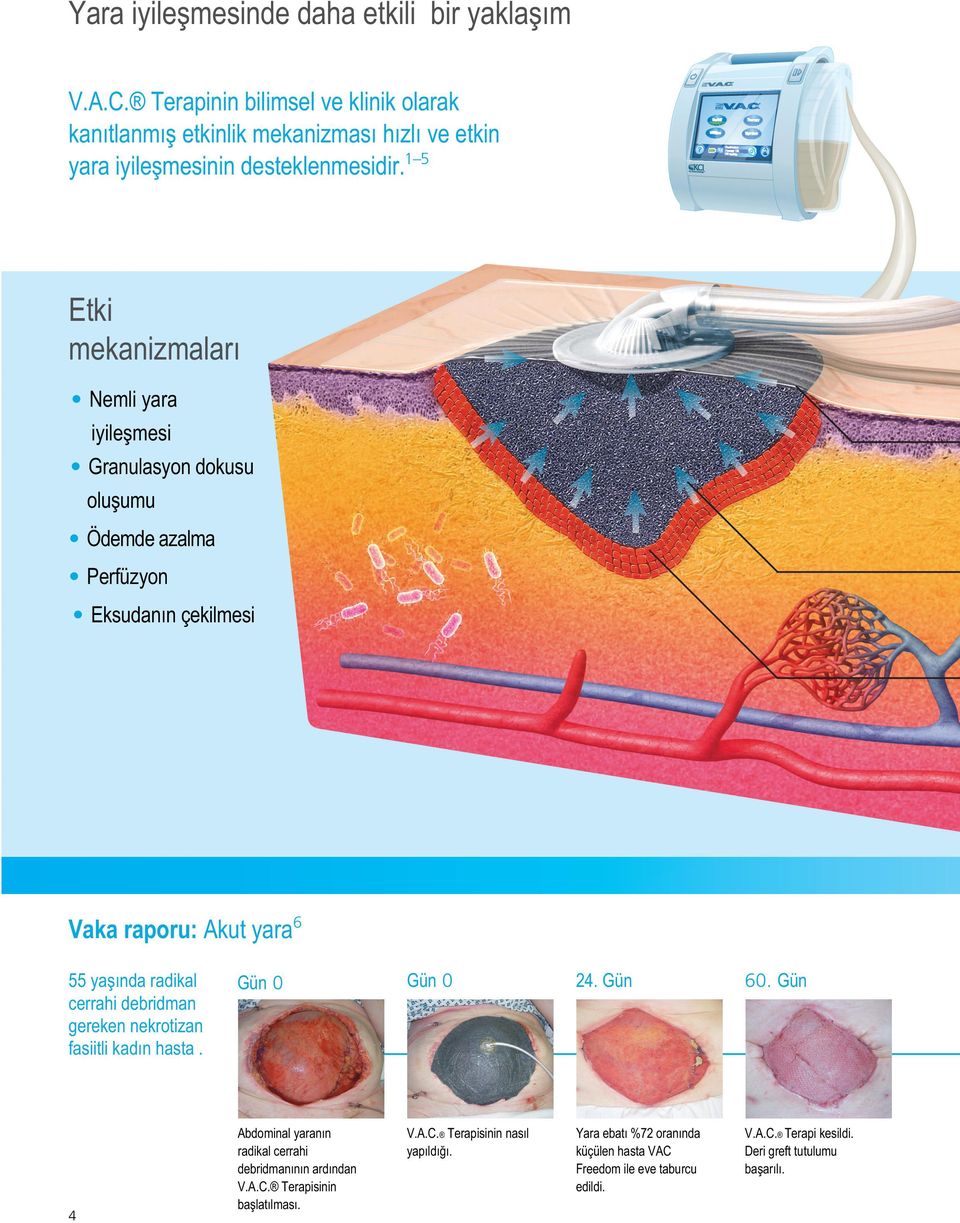 cerrahi debridman gereken nekrotizan fasiitli kadın hasta. 4 Gün 0 Gün 0 24. Gün 60. Gün Abdominal yaranın radikal cerrahi debridmanının ardından V.A.C.