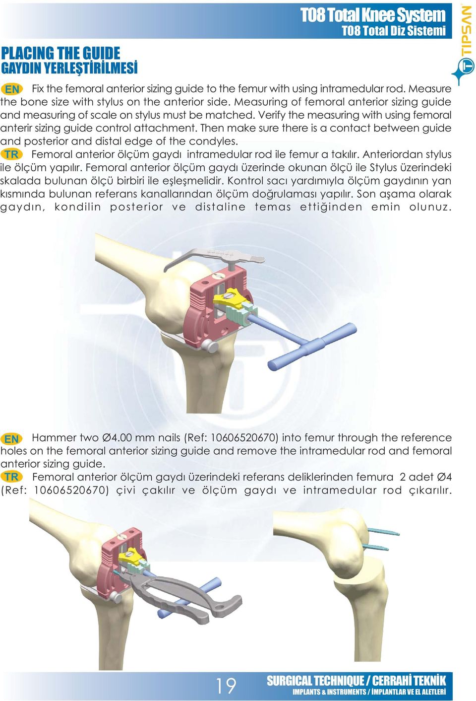 Then make sure there is a contact between guide and posterior and distal edge of the condyles. Femoral anterior ölçüm gaydý intramedular rod ile femur a takýlýr. Anteriordan stylus ile ölçüm yapýlýr.