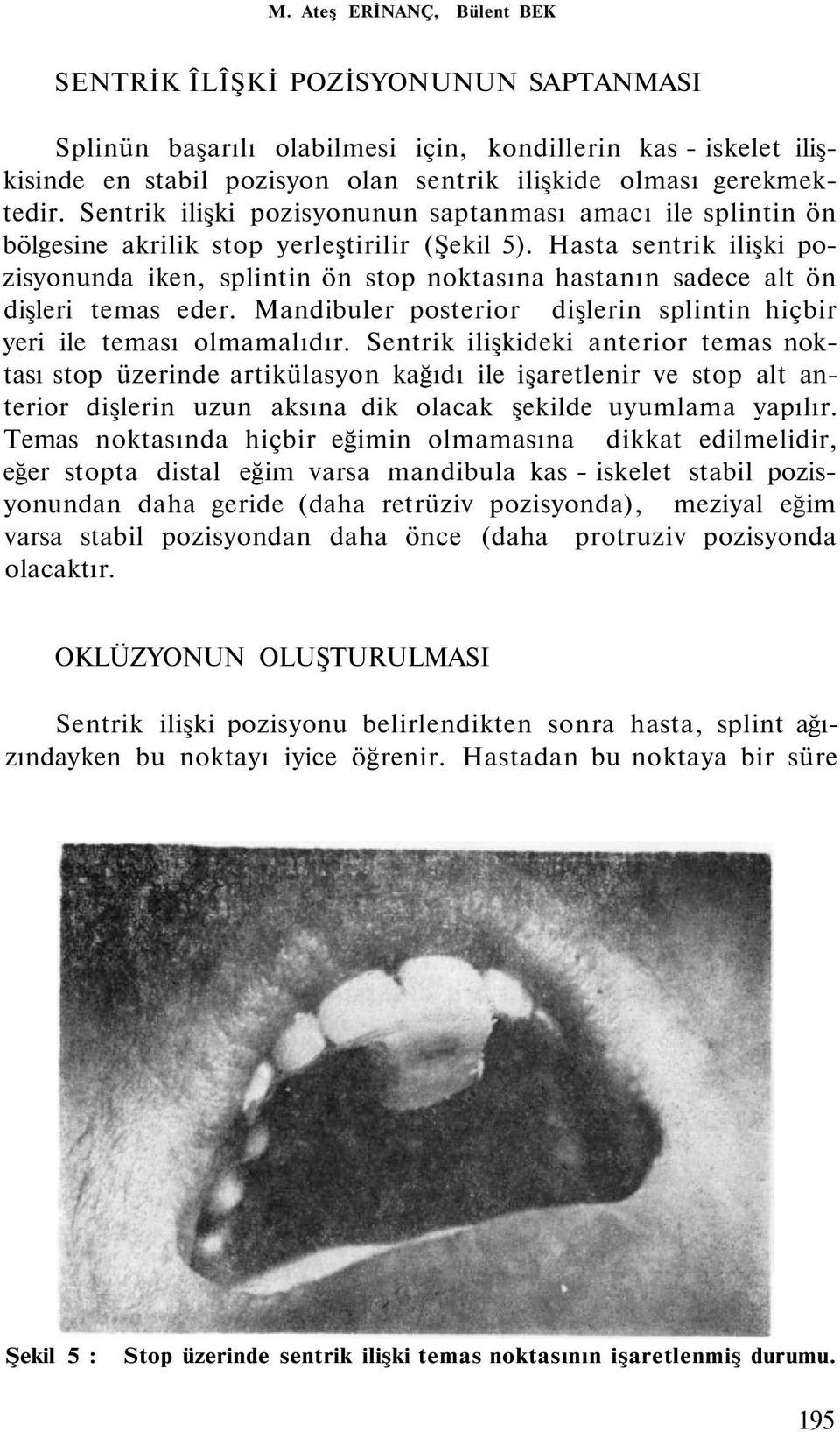 Hasta sentrik ilişki pozisyonunda iken, splintin ön stop noktasına hastanın sadece alt ön dişleri temas eder. Mandibuler posterior dişlerin splintin hiçbir yeri ile teması olmamalıdır.